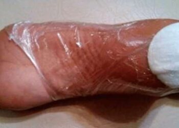 Mette un batuffolo di cotone sul tallone per la notte. Il risultato è incredibile