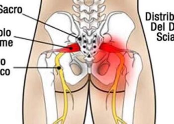 cosa-sapere-sulla-sciatica