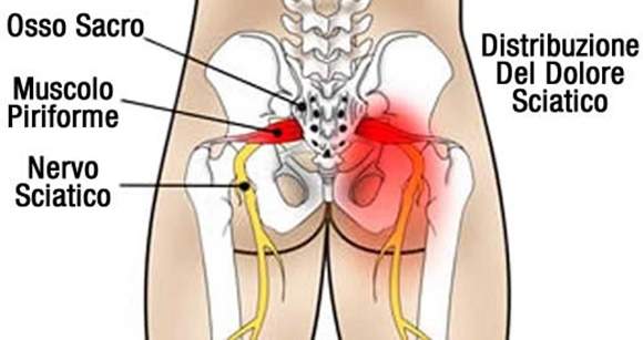cosa-sapere-sulla-sciatica