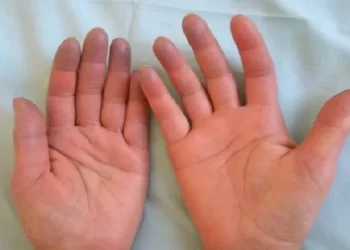 Sindrome di Raynaud: sintomi e cura