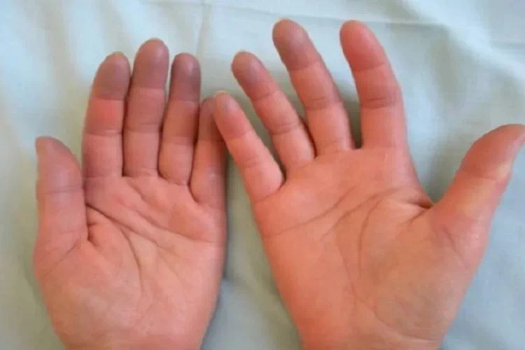 Sindrome di Raynaud: sintomi e cura