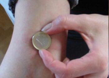 Allergia al Nichel, ne soffre il 32% in Italia: sintomi e diagnosi