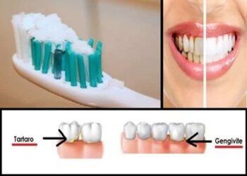 tartaro-e-placca-sui-denti