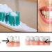 tartaro-e-placca-sui-denti