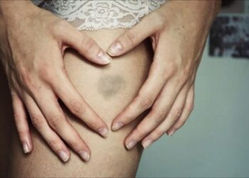 Lividi sul corpo e non sai come te li sei procurati? Cause e sintomi