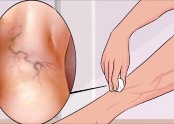 Vene Varicose? Combattile con aloe vera, carota e aceto di mele