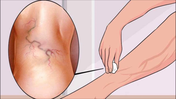Vene Varicose? Combattile con aloe vera, carota e aceto di mele