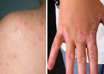 Intolleranza al glutine, i 10 sintomi principali di questo disturbo