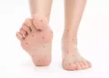 Sensazione delle formiche nelle gambe e sulle braccia