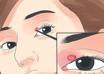 Calazio sulla palpebra, cos'è? Come trattare questa condizione