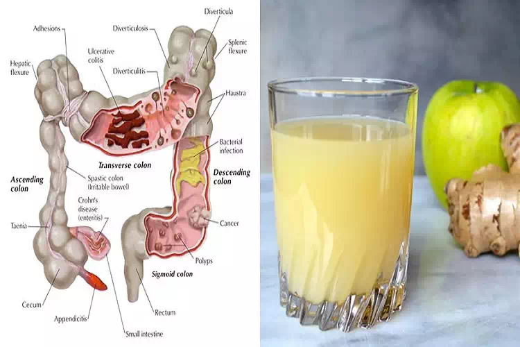 Il succo che svuota l’intestino da tossine