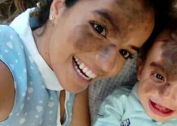 Il figlio nasce con una grossa macchia sul viso e la mamma se ne fa tatuare una uguale