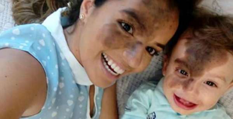 Il figlio nasce con una grossa macchia sul viso e la mamma se ne fa tatuare una uguale