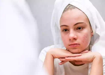 Rosacea fa scacco matto a 1 persona su 5
