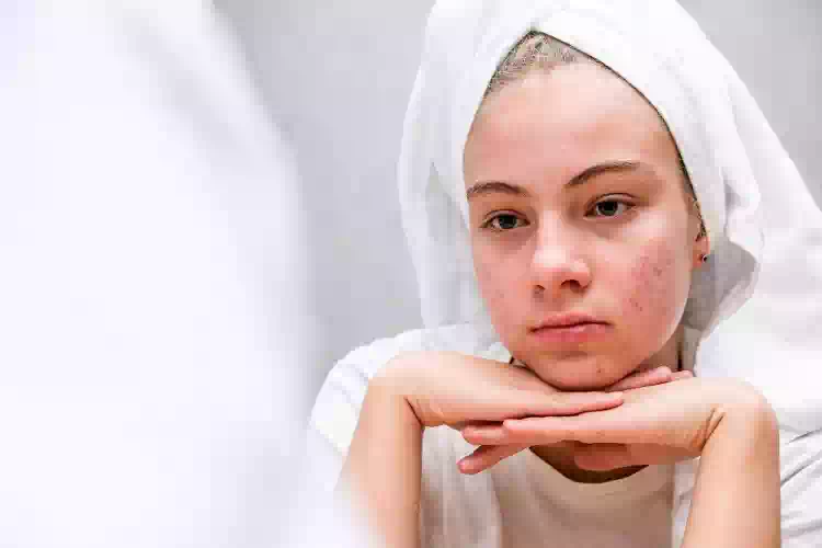 Rosacea fa scacco matto a 1 persona su 5