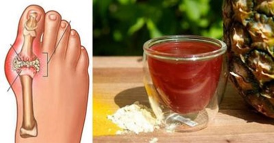 8 Rimedi naturali ed efficaci per alleviare i sintomi della gotta