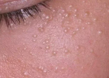 Come eliminare cisti e palline di grasso