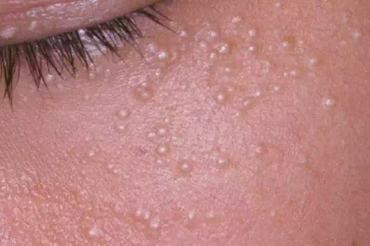 Come eliminare cisti e palline di grasso
