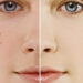 Come eliminare acne e punti neri per sempre con il bicarbonato di sodio
