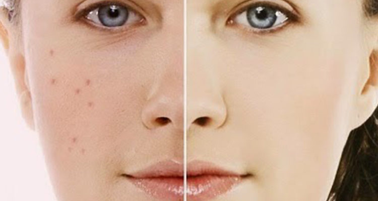 Come eliminare acne e punti neri per sempre con il bicarbonato di sodio