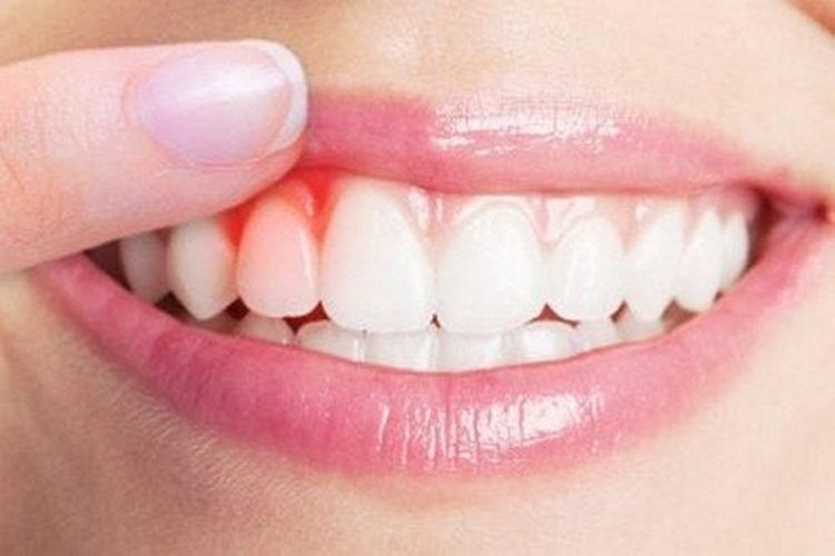 Collutorio fatto in casa per prendersi cura di denti e gengive!