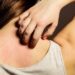 Dermatite: i trattamenti migliori per alleviarla, dalla dieta alla psicosomatica