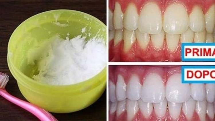 Come sbiancare i denti