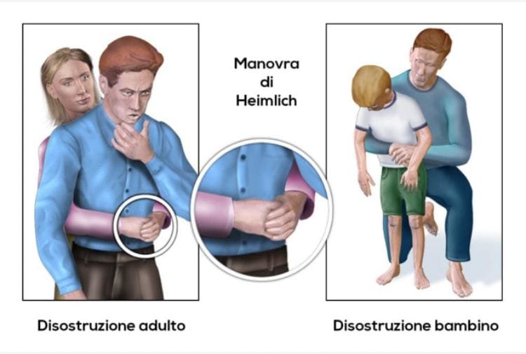 Manovra di Heimlich, la tecnica che salva la vita delle persone