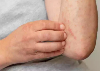 Dermatite atopica
