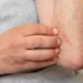 Dermatite atopica