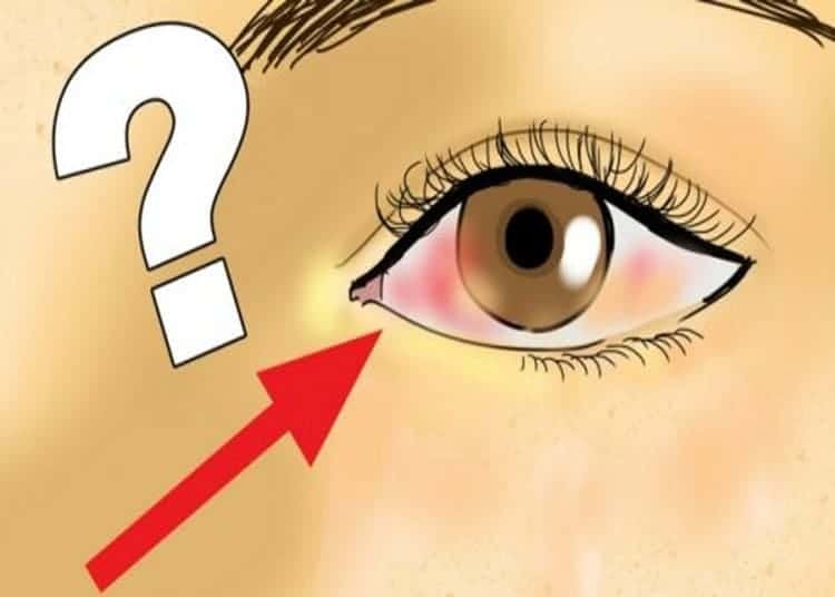 distacco-della-retina
