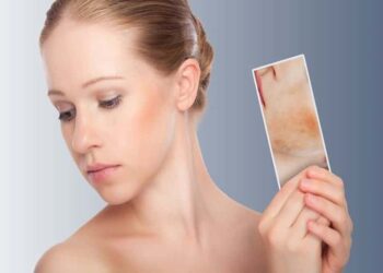psoriasi-rimedi-aloe-vera