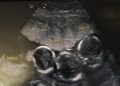Giovane mamma partorisce