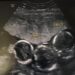 Giovane mamma partorisce