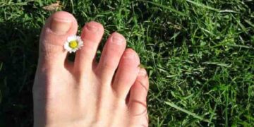 unghie dei piedi gialle-min