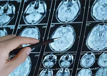 Alzheimer, ecco i dieci sintomi